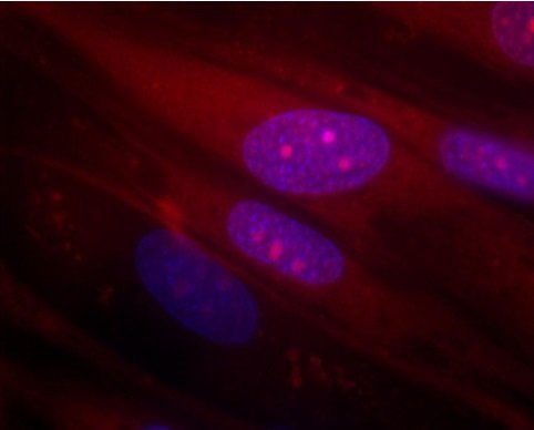 Ryc. 2 Wchłanianie DNA przez komórki i jądro komórek HFF1 po permeabilizacji saponiną (czerwone Cy-3 połączone z niebieskim jądrem)