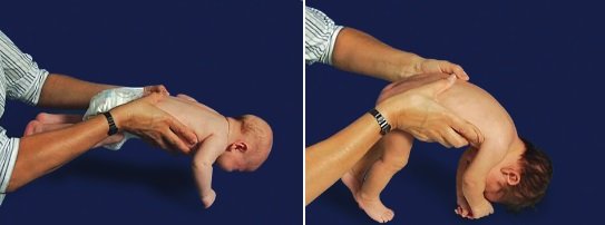 Rozwój motoryczny 2-miesięcznych niemowląt - Wyprost Obronny