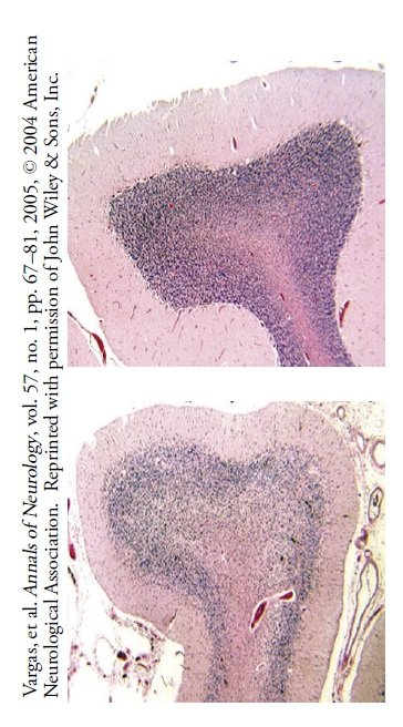 Komórki Purkinjego (fioletowoniebieskie kropki) w normalnym ludzkim móżdżku.