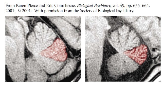 Skan MRI móżdżku kontrolnego dziecka (po lewej) i dziecka autystycznego (po prawej), z płacikami VI i VII w kolorze czerwonym