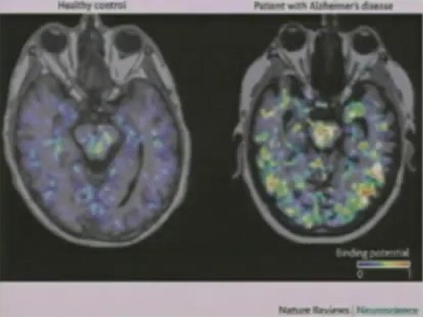mózg osoby chorej na Alzheimera