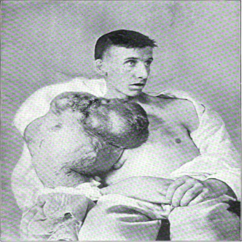 Benjamin F. Olewine, Altoona, Pensylwania. Zaszczepiony zimą 1895 roku, będąc wówczas w dobrym zdrowiu, o gładkiej i czystej skórze