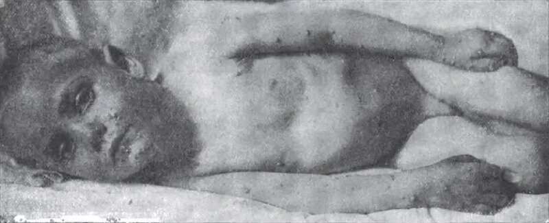 „Niezwykle łagodny przypadek ospy prawdziwej, wykazujący pewne podobieństwo do ospy wietrznej”, American Medicine, t. II, nr 23, 7 grudnia 1901, s. 901.