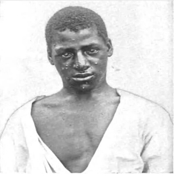 „Ospa prawdziwa z łagodną postacią obserwowana w ostatnich latach w wielu regionach Stanów Zjednoczonych.” Jay Frank Schamberg, MD, Diseases of the Skin and Eruptive Fevers, 1908, s. 408.