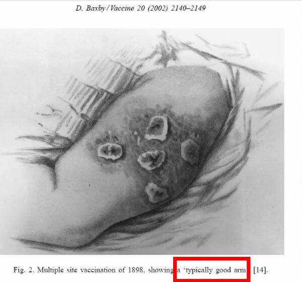 Szczepienie wielomiejscowe z 1898 r. przedstawiające „typową dobrą reakcję ramienia”